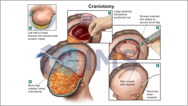 Medical Demonstratives_6_Craniotomy