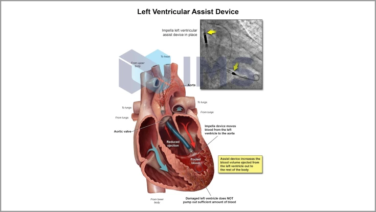Medical Demonstratives_8_Ventricular Assist Device