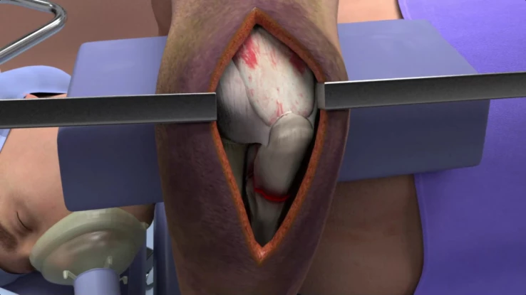 6_Elbow_Surgery_thumbnail