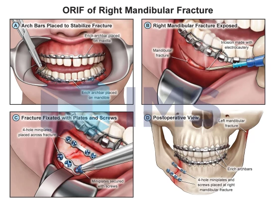 1_Mandibular Fracture