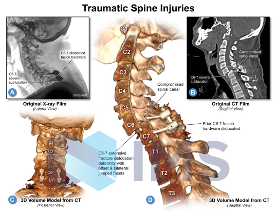 3_Traumatic Spine Injuries