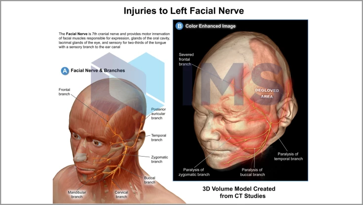 Medical Demonstratives_4_Left Facial Nerve
