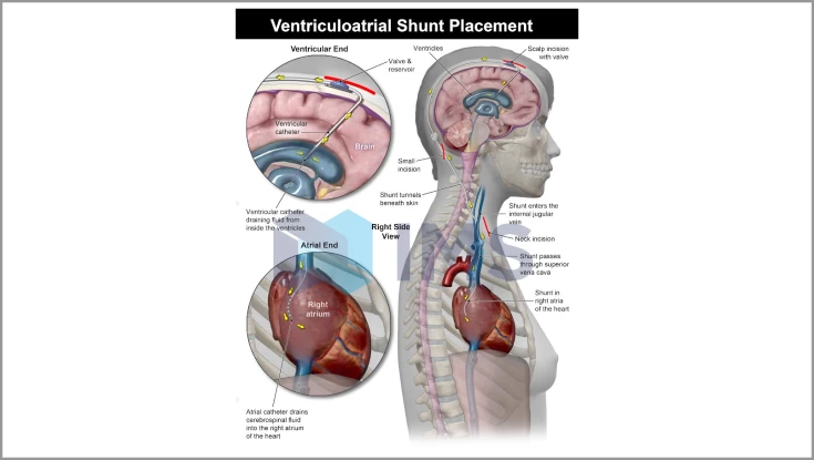 Medical Demonstratives_9_Ventriculoartrial Shunt