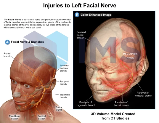 4_Left Facial Nerve