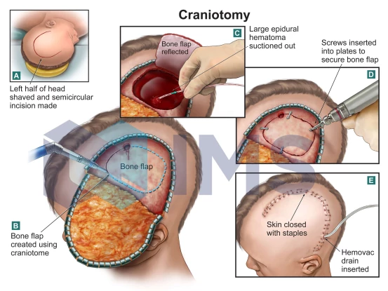 6_Craniotomy
